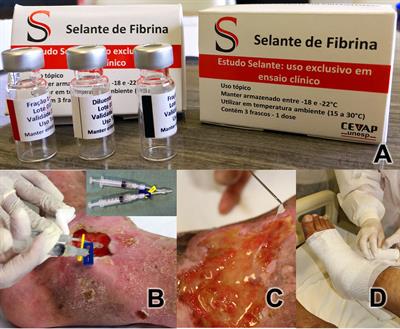 Treatment of Chronic Venous Ulcers With Heterologous Fibrin Sealant: A Phase I/II Clinical Trial